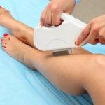 Exemple epilation laser