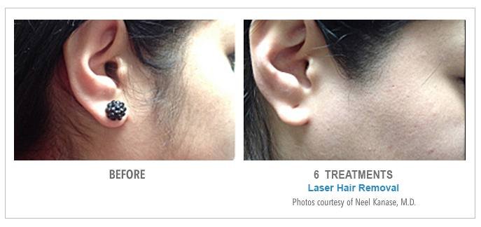 Laser Hair Removal Before & After Photos - Sideburns