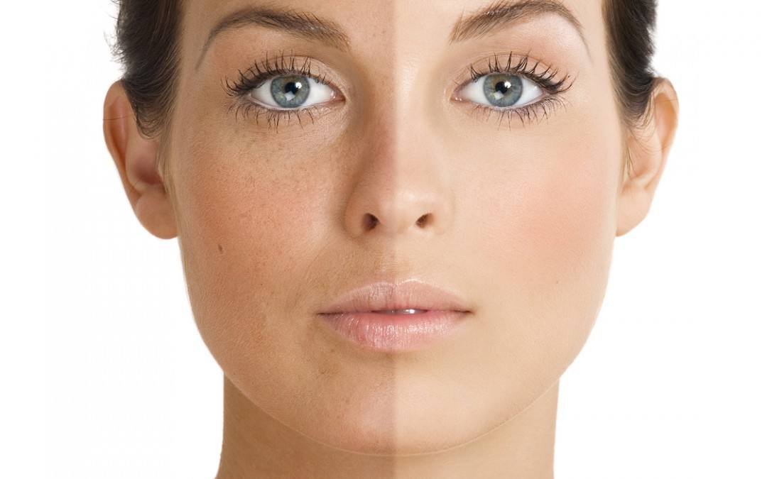 Iv Hydration and melasma