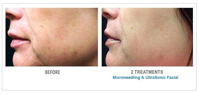 Microneedling
