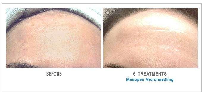 microneedling