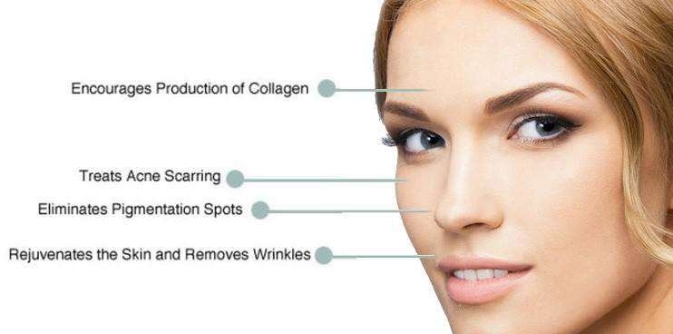 microneedling