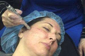 microneedling amarillo
