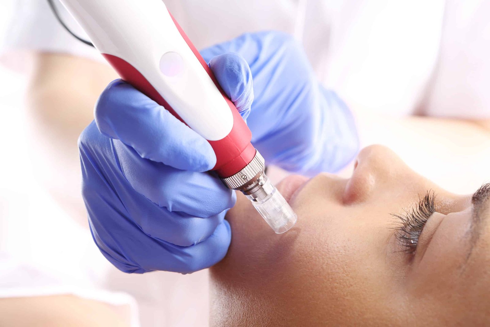 microneedling amarillo