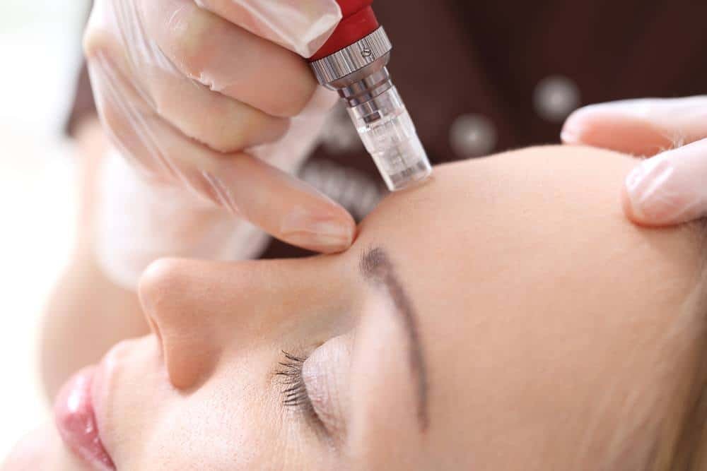 microneedling Lubbock