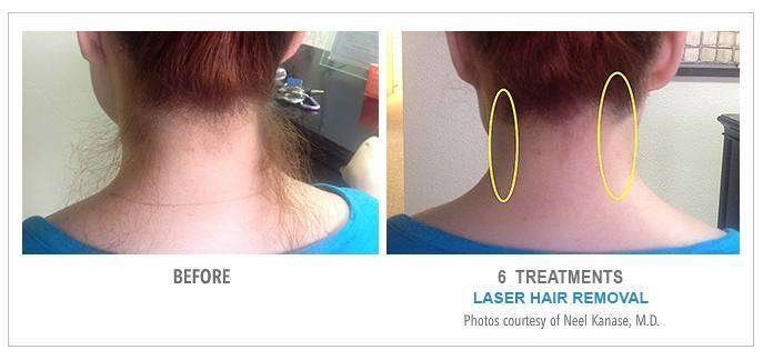 LHR Neck