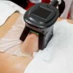 CoolSculpting
