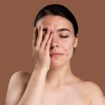 Acne-Prone Skin