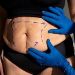 CoolSculpting Experience