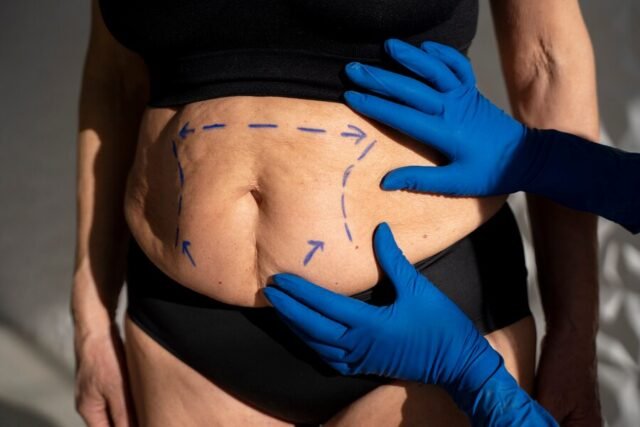 CoolSculpting and Liposuction