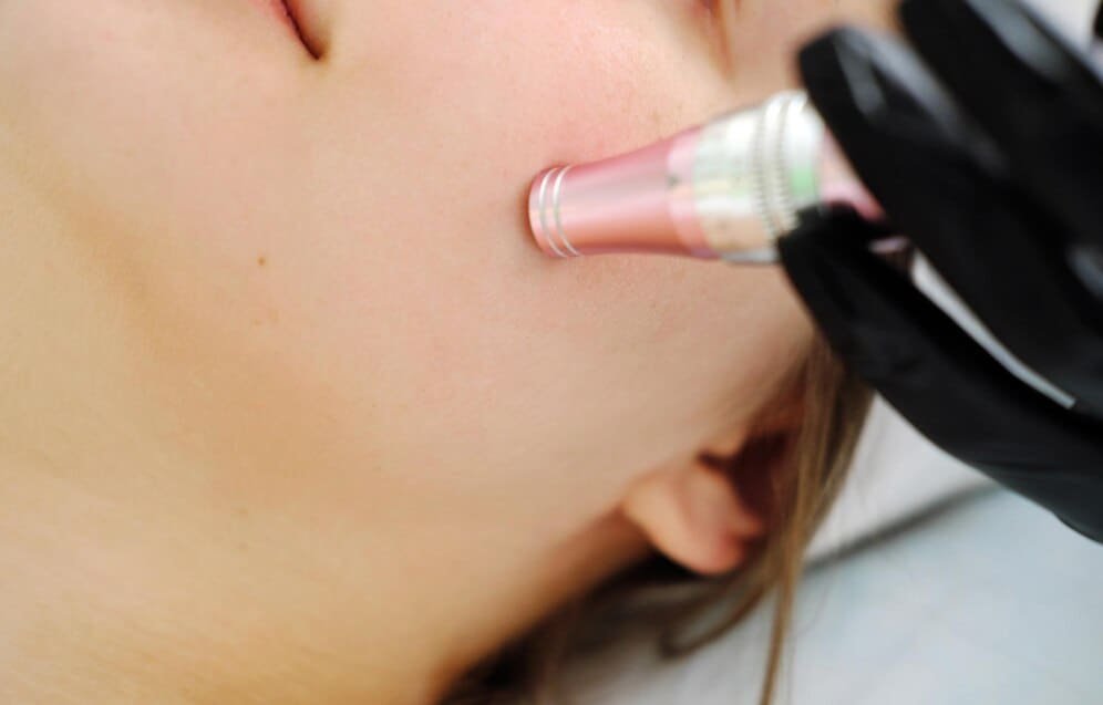 closeup-microneedling-treatment-skin_115318-10715