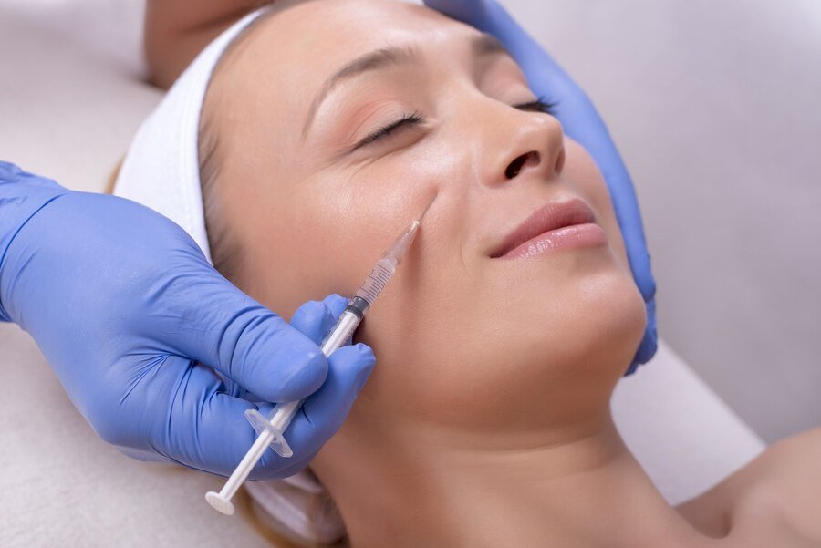 Juvederm for Cheeks