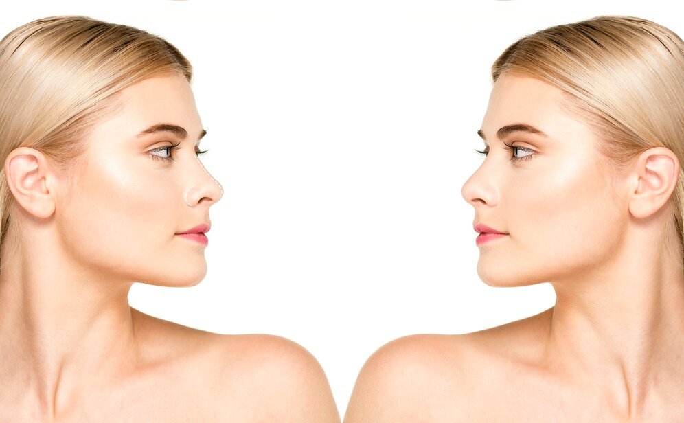 Nasolabial Fold Juvederm