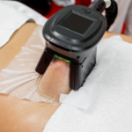 CoolSculpting Cost