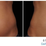 quick-coolsculpting-amarillo-achieve-your-dream-body-faster