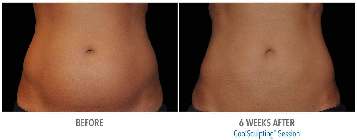quick-coolsculpting-amarillo-achieve-your-dream-body-faster