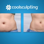 coolsculpting