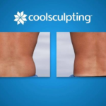 CoolSculpting