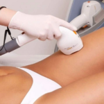 Painless Laser Hair Removal