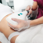Amarillo CoolSculpting