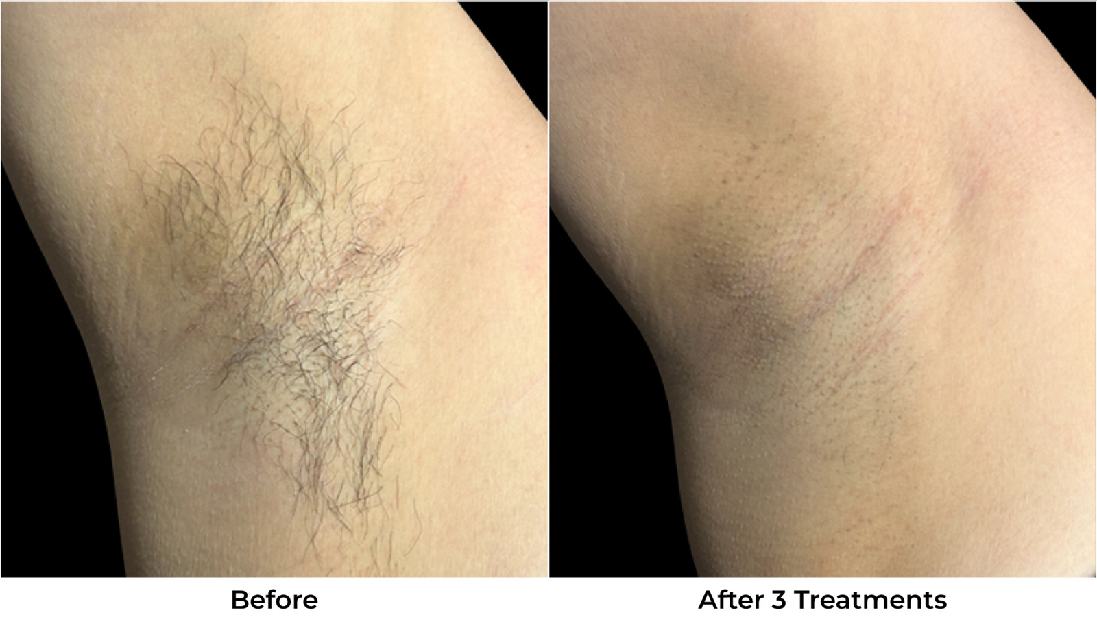 Laser Hair Removal Before & After Photos - Back