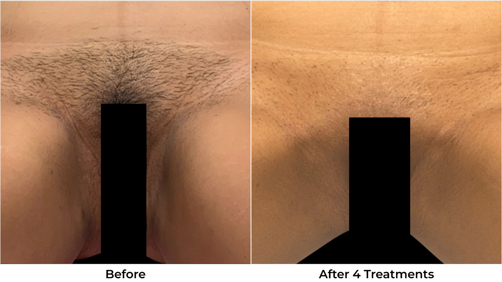 Laser Hair Removal Before & After Photos - Back