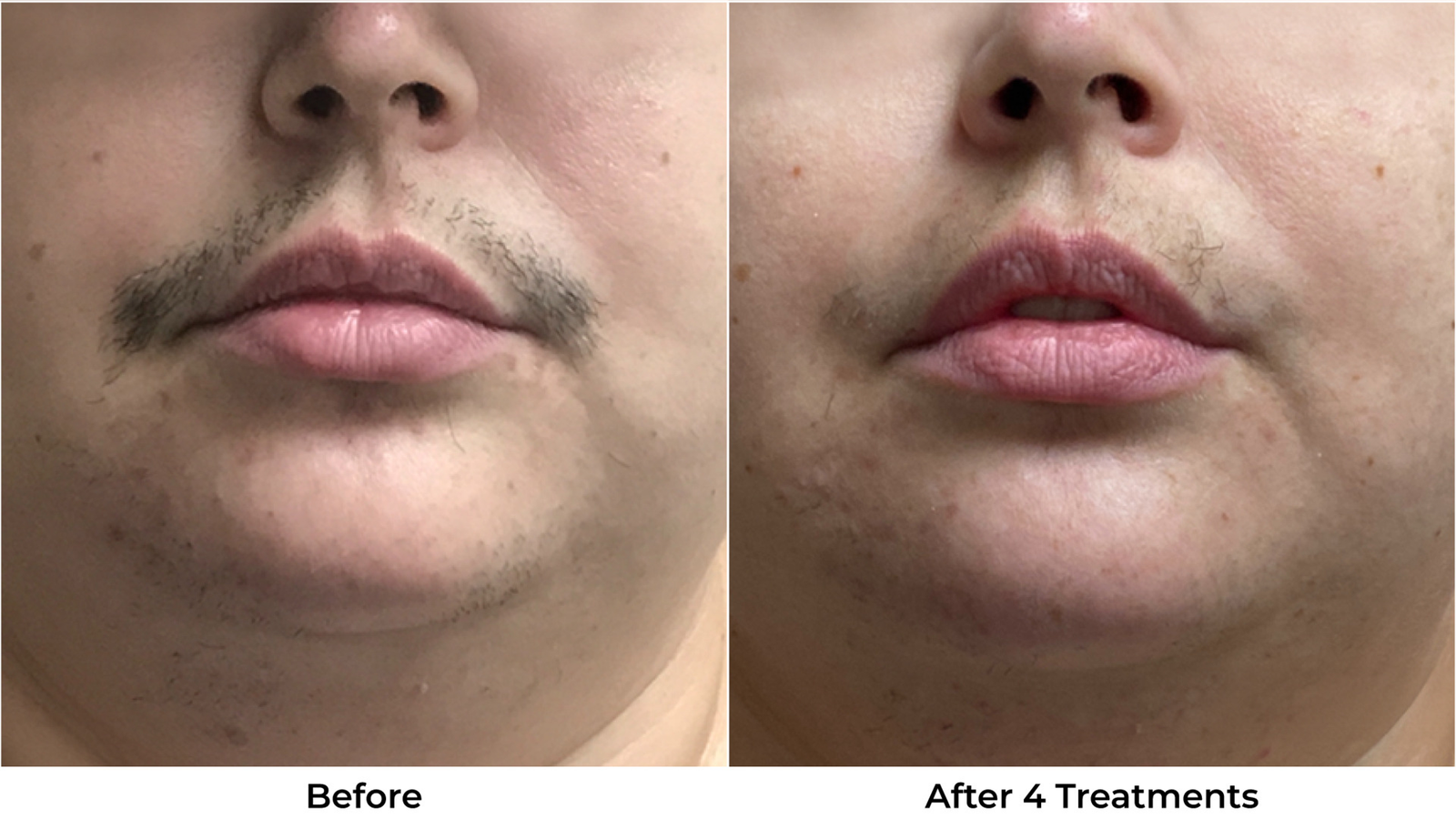 Laser Hair Removal Before & After Photos - Back