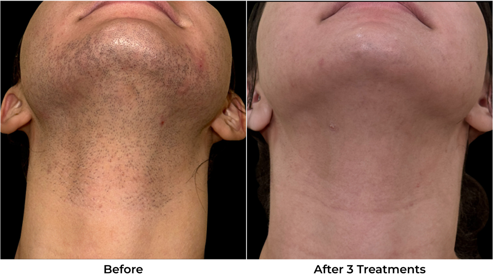 Laser Hair Removal Before & After Photos - Back
