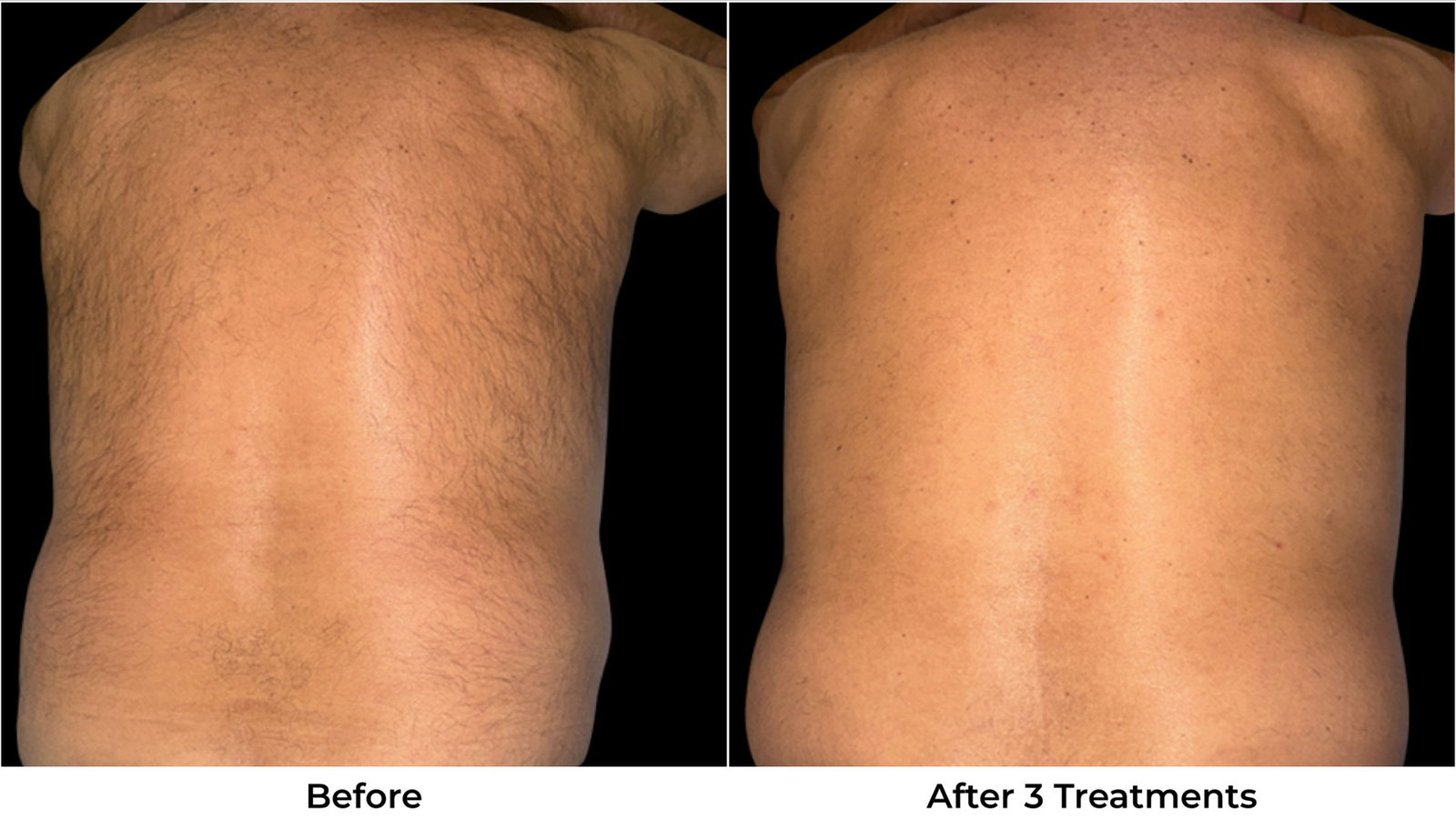Laser Hair Removal Before & After Photos - Back